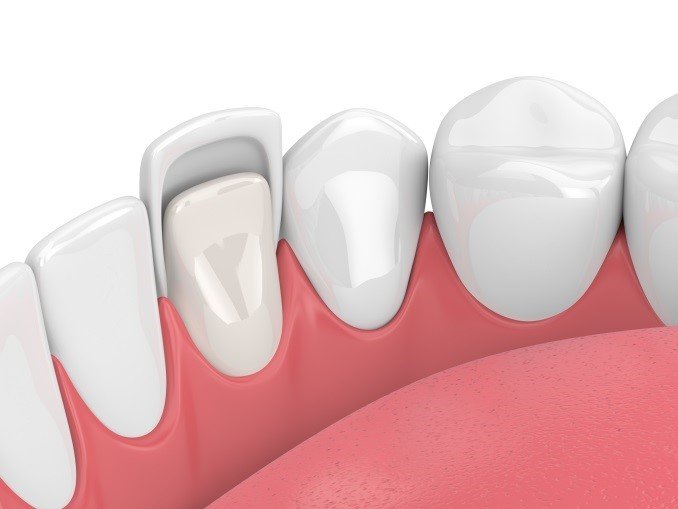 veneers dentist Las Vegas